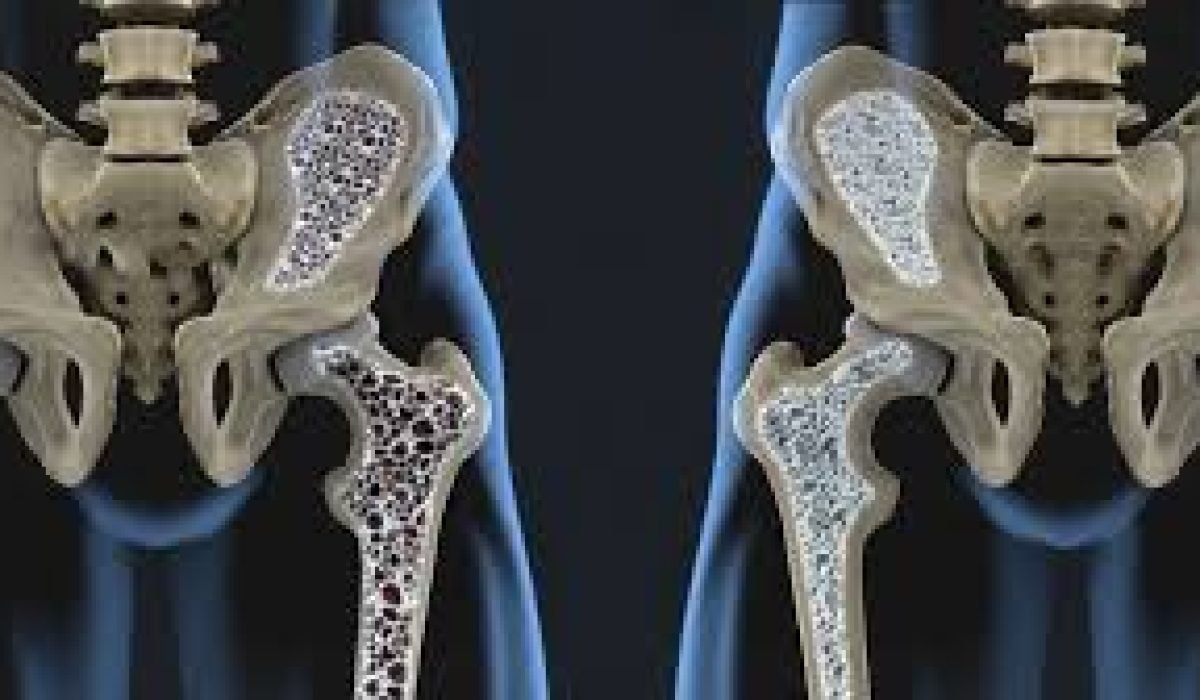 Osteop